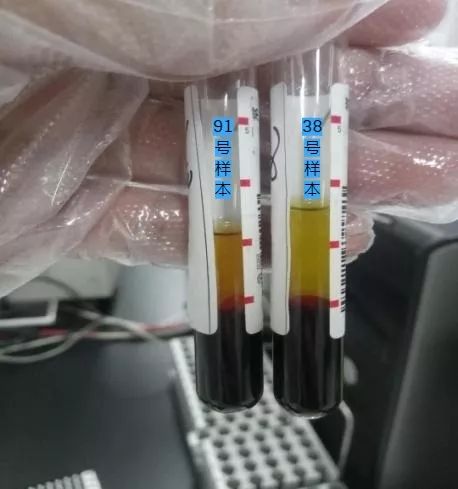 可以发现91号标本血清颜色没有38号清亮,判断91号标本发生了隐性溶血
