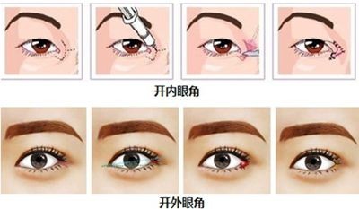 开眼角会产生疤痕 眼角部位的皮肤非常薄,开内眼角术后切口疤痕是客观