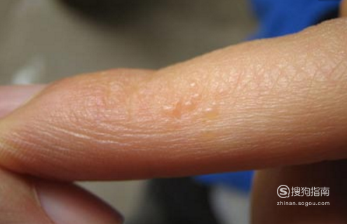 汗疱疹症状是什么?手起汗疱疹怎么治疗?