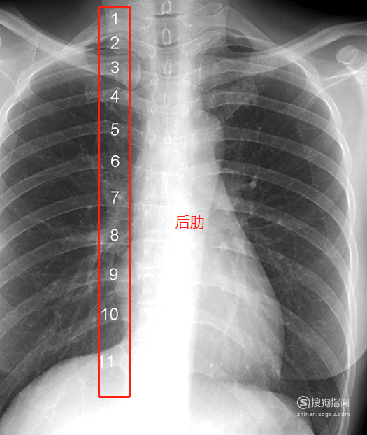 教你怎么看正常的胸片.