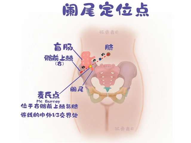 阑尾炎是哪个部位疼