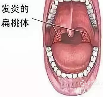如何摸到自己的扁桃体 368_324_20200401144135-1920970656.png