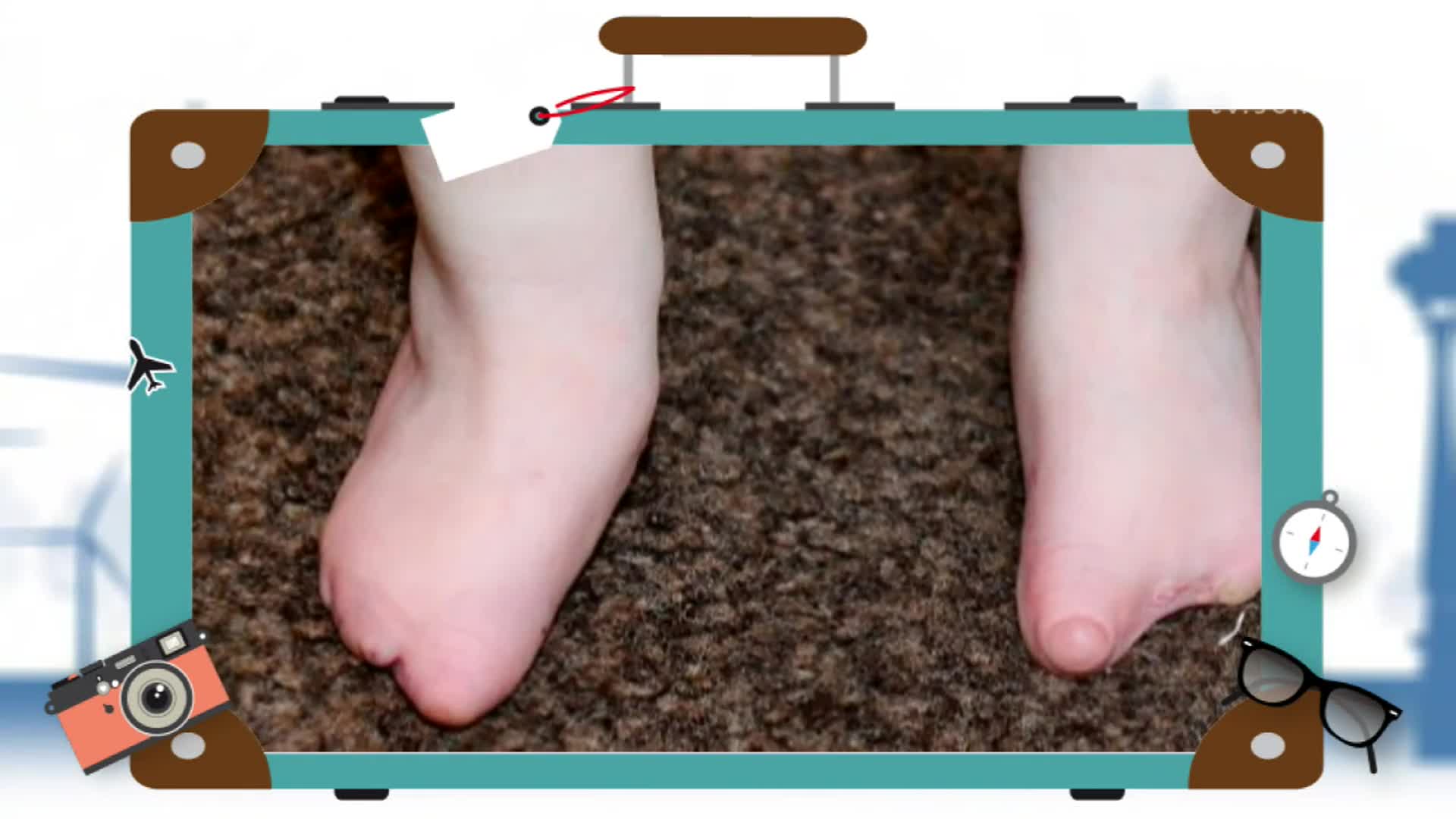 4岁女孩天生没有脚趾 勤学芭蕾立志成为舞蹈家