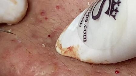 皇冠姑娘挤痘痘最佳粉刺弹出p2超级迷人的粉刺18