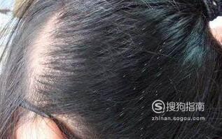 头发长虱子的处理方法头发上有虱子该怎么治4.8万阅读 头发长虱子的处理方法