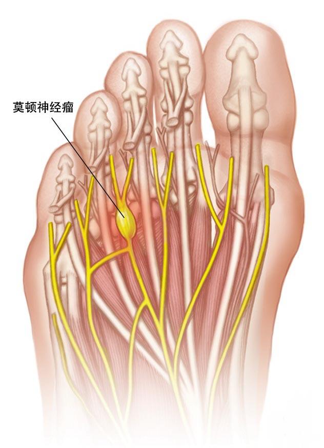莫顿神经瘤是会导致脚痛的一种神经组织增生症,即通向脚趾的一根神经